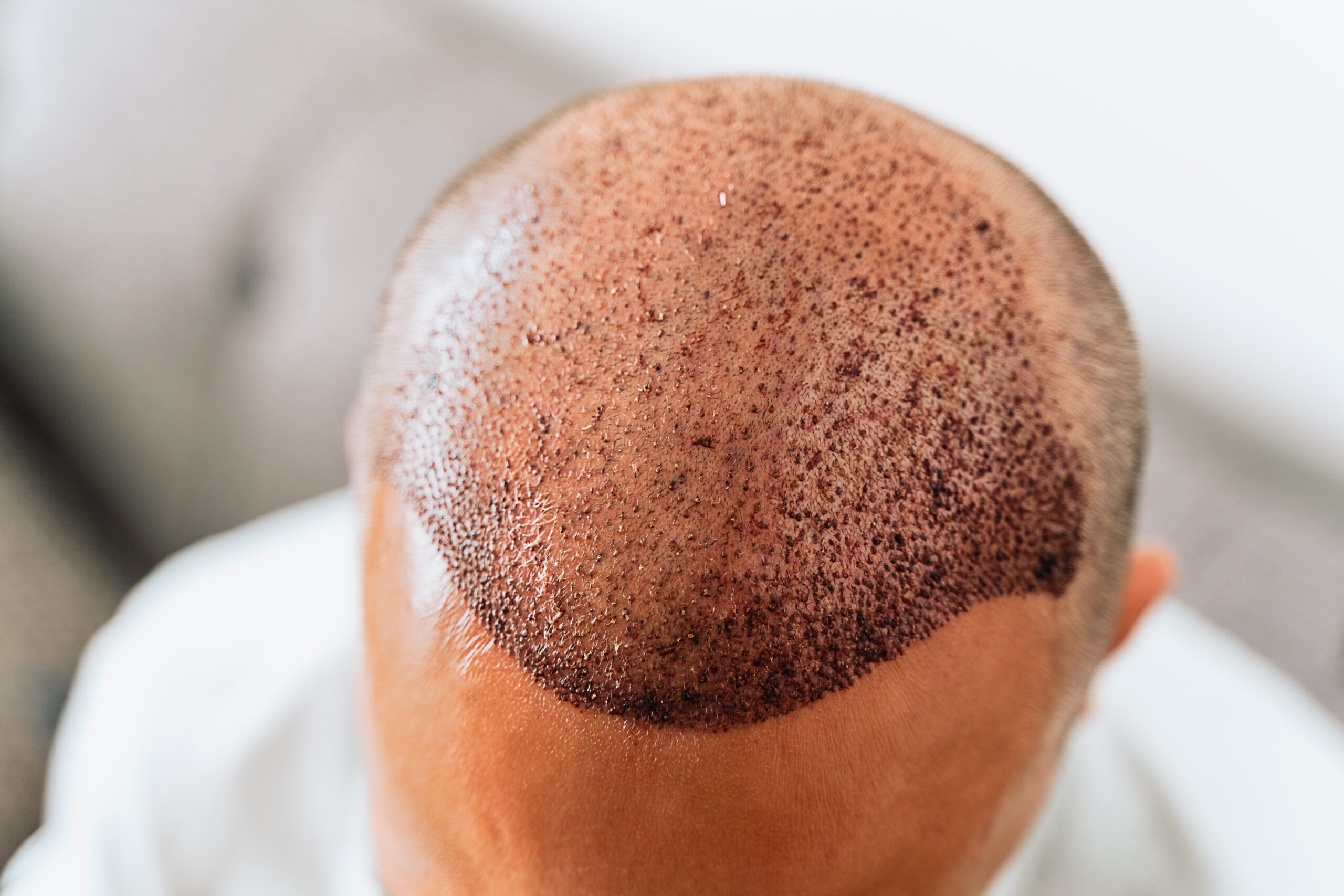 after hair transplantation surgical technique that 2023 11 27 05 21 08 utc scaled